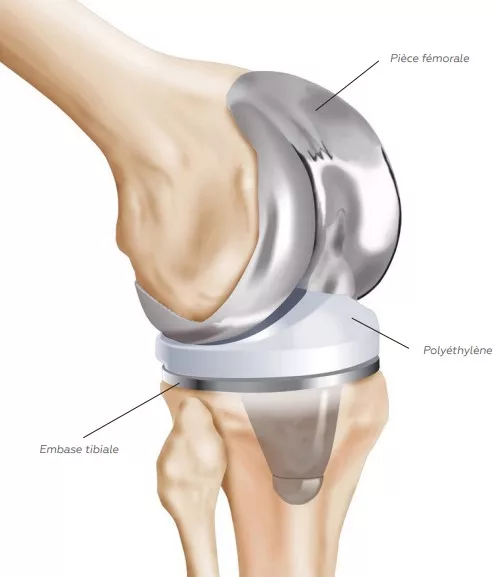 Prothèse Totale de Genou Bordeaux